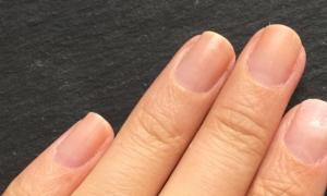 Nails as an “indicator” of your health. A pit on the nail of the thumb of the left hand.