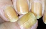 Nowoczesne leczenie grzybicy paznokci
