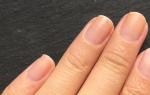 Las uñas como “indicador” de tu salud Un hoyo en la uña del pulgar izquierdo