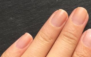 Las uñas como “indicador” de tu salud Un hoyo en la uña del pulgar izquierdo